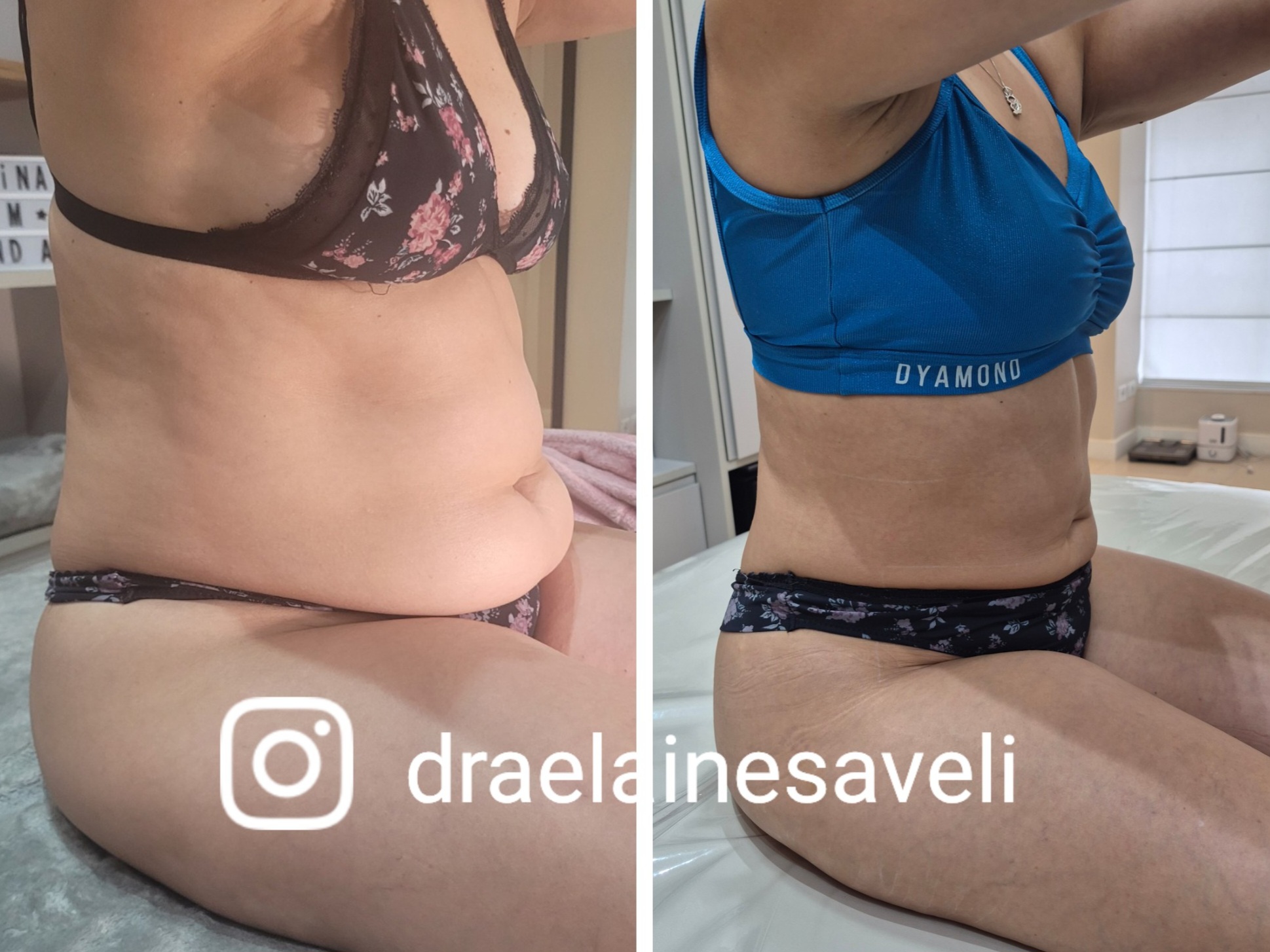Antes e depois · Body Sculpt