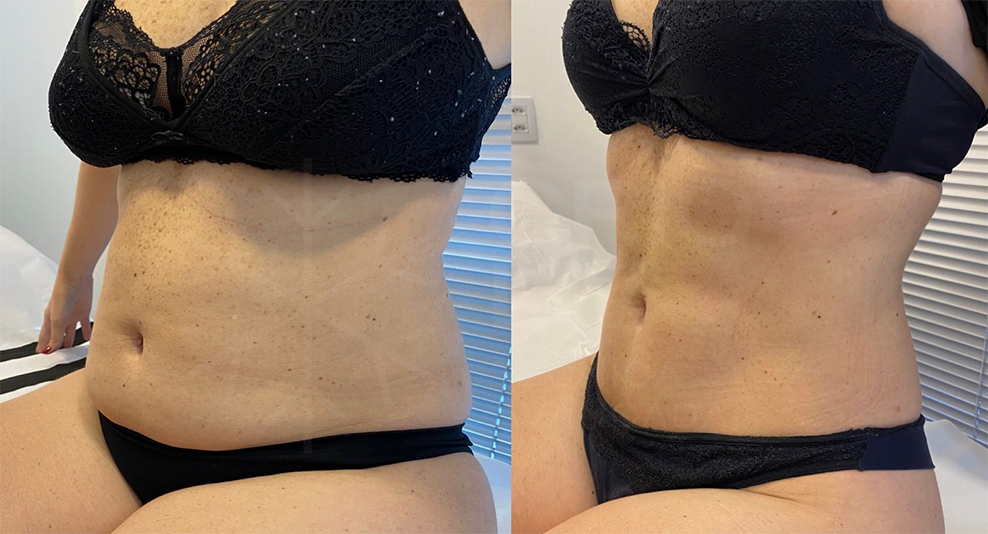 Antes e depois · Body Sculpt
